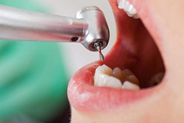 Best Emergency Tooth Extraction in Falls City, NE
